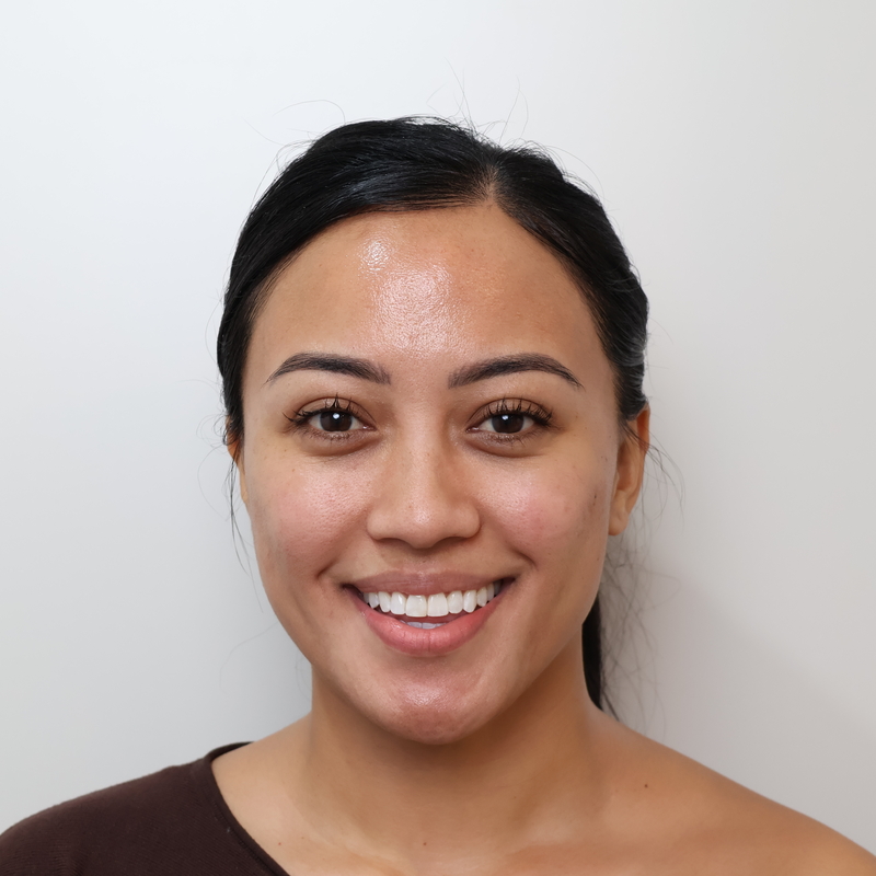 After Invisalign treatment result
