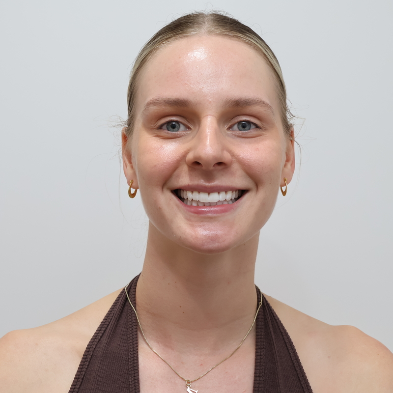After Invisalign treatment result
