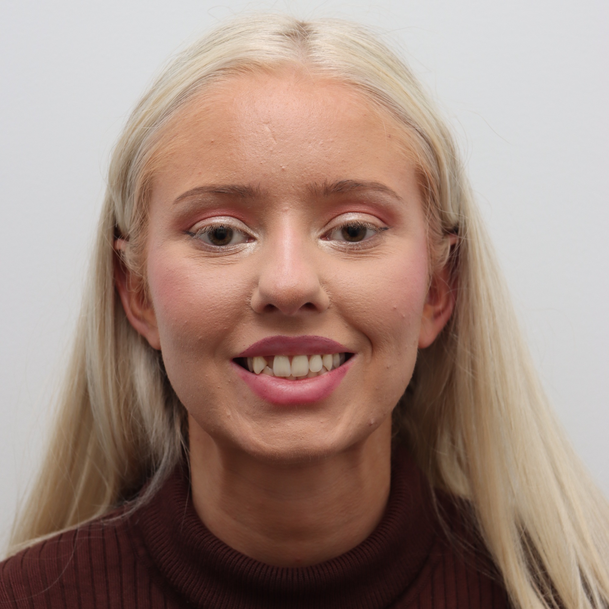 Before Invisalign treatment result